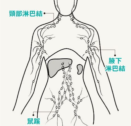 【淋巴癌】醫言有理：淋巴癌擴全身 仍有逾半機會治癒