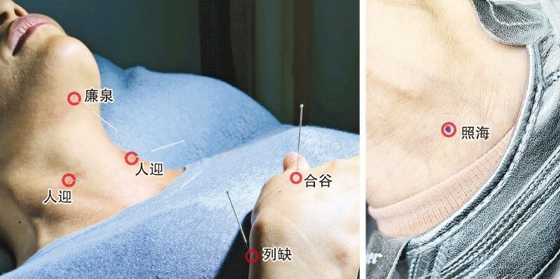 對付聲帶小結瘜肉 中醫灸聲 沙啞拜拜