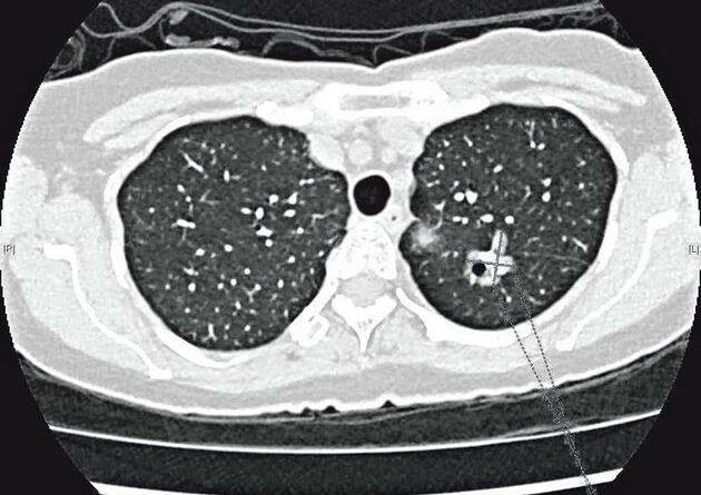 【了解肺癌】研究：肺癌提早用免疫療法　增存活期