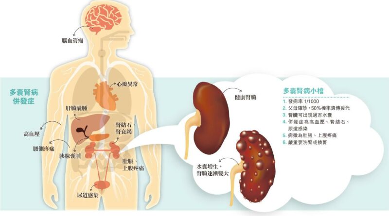 【有片】控血壓減換腎風險 遺傳泡泡腎 千人一中招