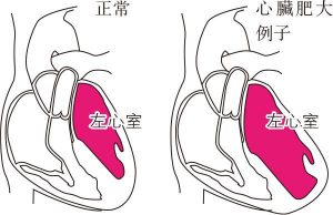 唔使睇醫生; 心臟肥大; 高血壓