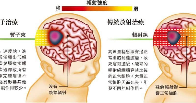 質子治療副作用低 兒童抗癌救星