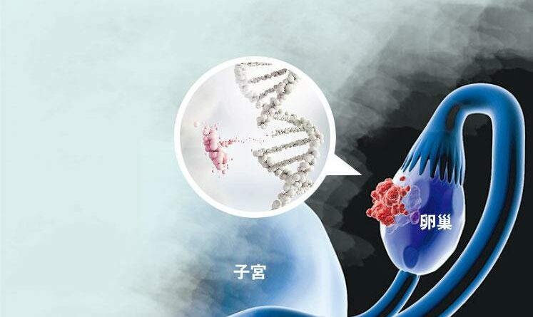 卵巢癌,乳癌,前列腺癌,胰臟癌,癌症,腫瘤,BRCA基因突變,PARP