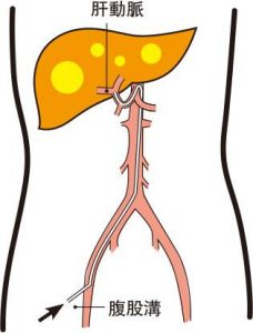 0401-pancreas-cancer-3