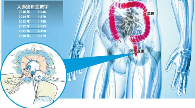 預防大腸癌貼士：多菜少肉 每天運動30分鐘