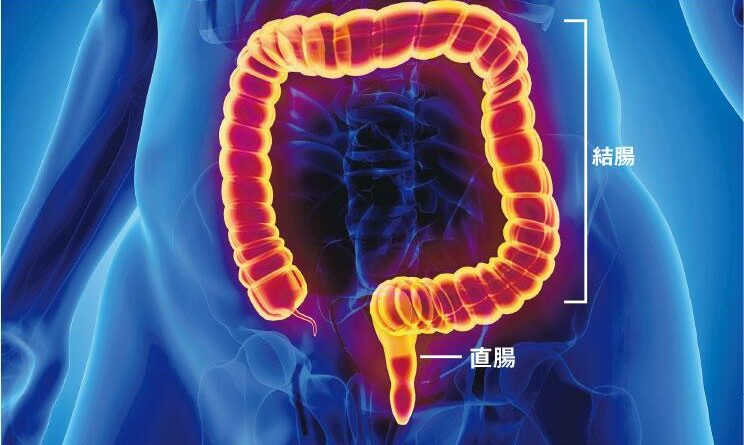 切除系膜 大腸癌連根拔起 新式微創手術增存活率