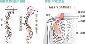 0603-shoulder-pain-upper-cross-syndrome-spine