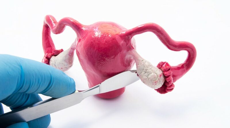 【婦科疾病系列】卵巢囊腫勿忽視 了解朱古力瘤治療方法