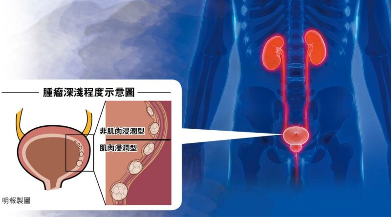 磁力共振新技術 膀胱癌睇真啲