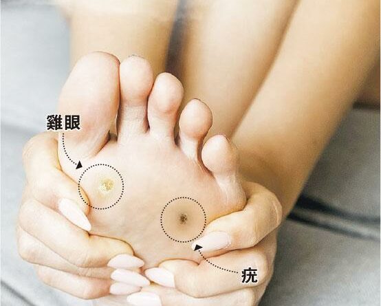 一隻「眼」 分清腳繭腳疣