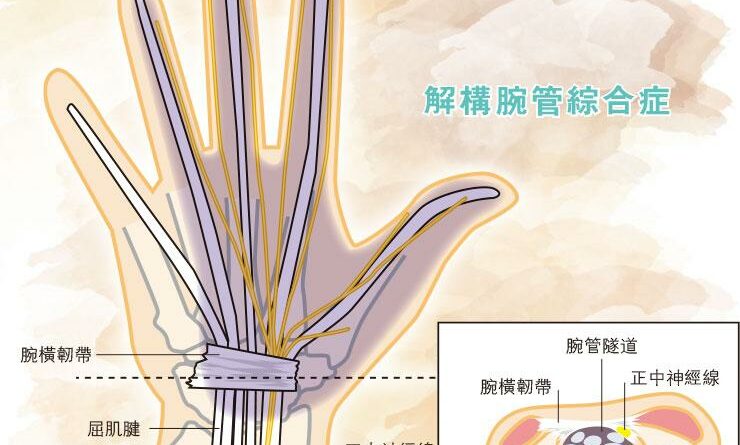 手痹手麻 入夜特別痛 握拳屈掌 揮別腕管綜合症
