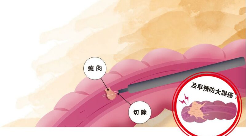 大腸癌