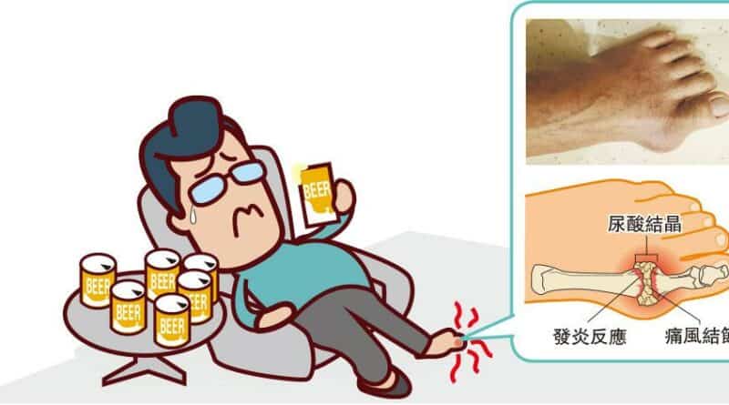醫路同行：痛風不治本 頑「石」纏身