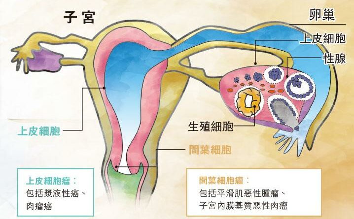 【子宮體癌】罕見婦科癌 徵狀相似 療法大不同