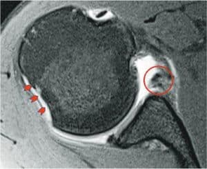 Bankart lesion_20210222_03