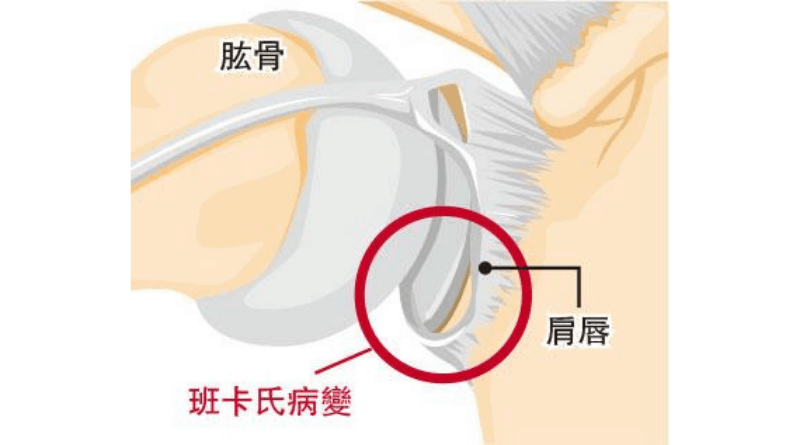 【肩關節脫位】慣性甩骱 伸懶腰都出事？ 20歲前受傷 再脫位風險近90％