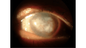 Health Header_Penetrating Keratoplasty_20210430_01