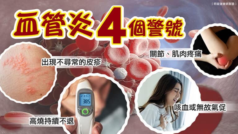 血管炎種類多、徵狀多變難察覺 注意四警號:皮疹、發燒、關節痛、疲倦 宜及早求醫 - 明報健康網