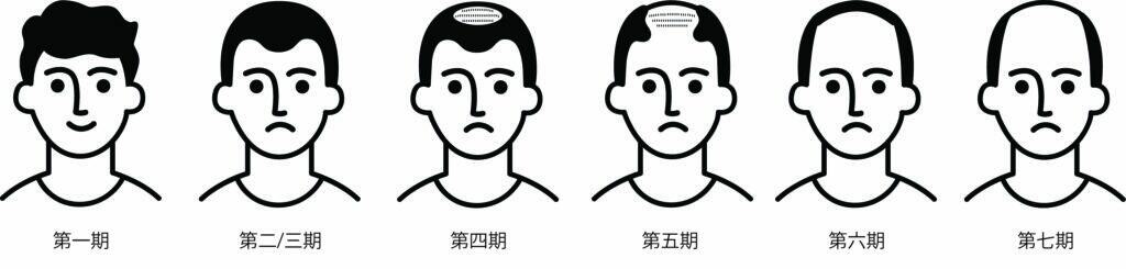 初期M字額年輕化！男士食生冷食物傷毛囊 髮線更易後移
