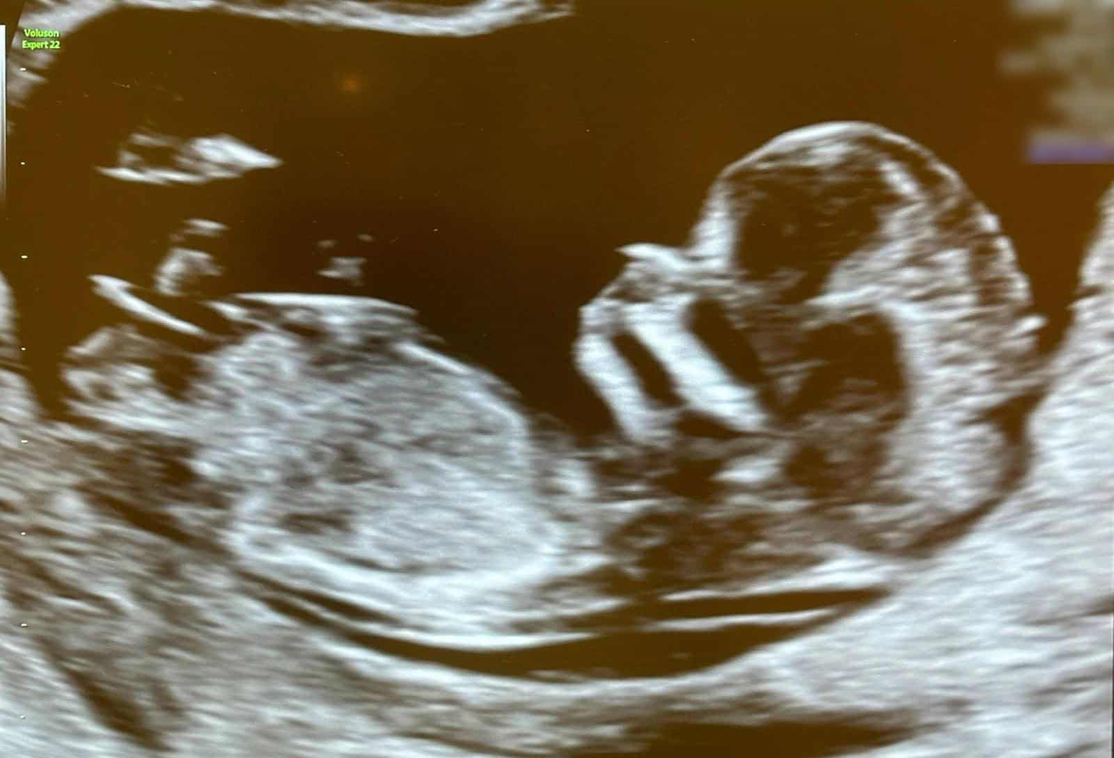 早孕期結構性超聲波詳細評估胎兒結構- 明報健康網