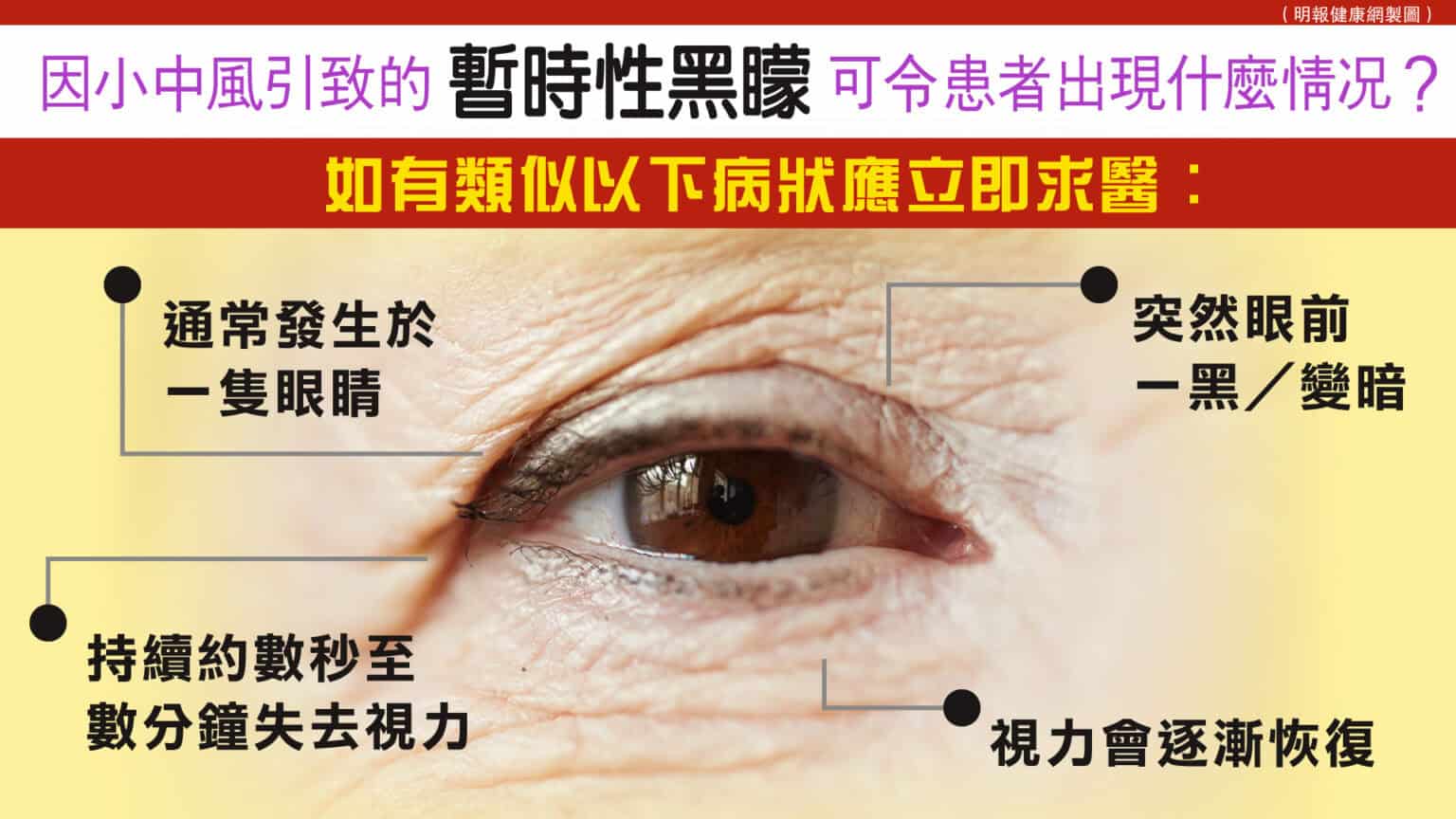 小心暫時性黑矇或腦中風來襲！突然眼前一黑只是眼疾？瞬間恢復視力便不用求醫？ - 明報健康網