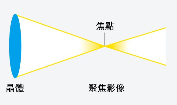 白內障手術植入人工晶體後 近視老花有變 再配眼鏡要考慮？