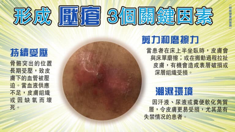 壓瘡初期似皮膚敏感？病情分4期 缺專業護理可急速惡化 4個預防方法 - 明報健康網