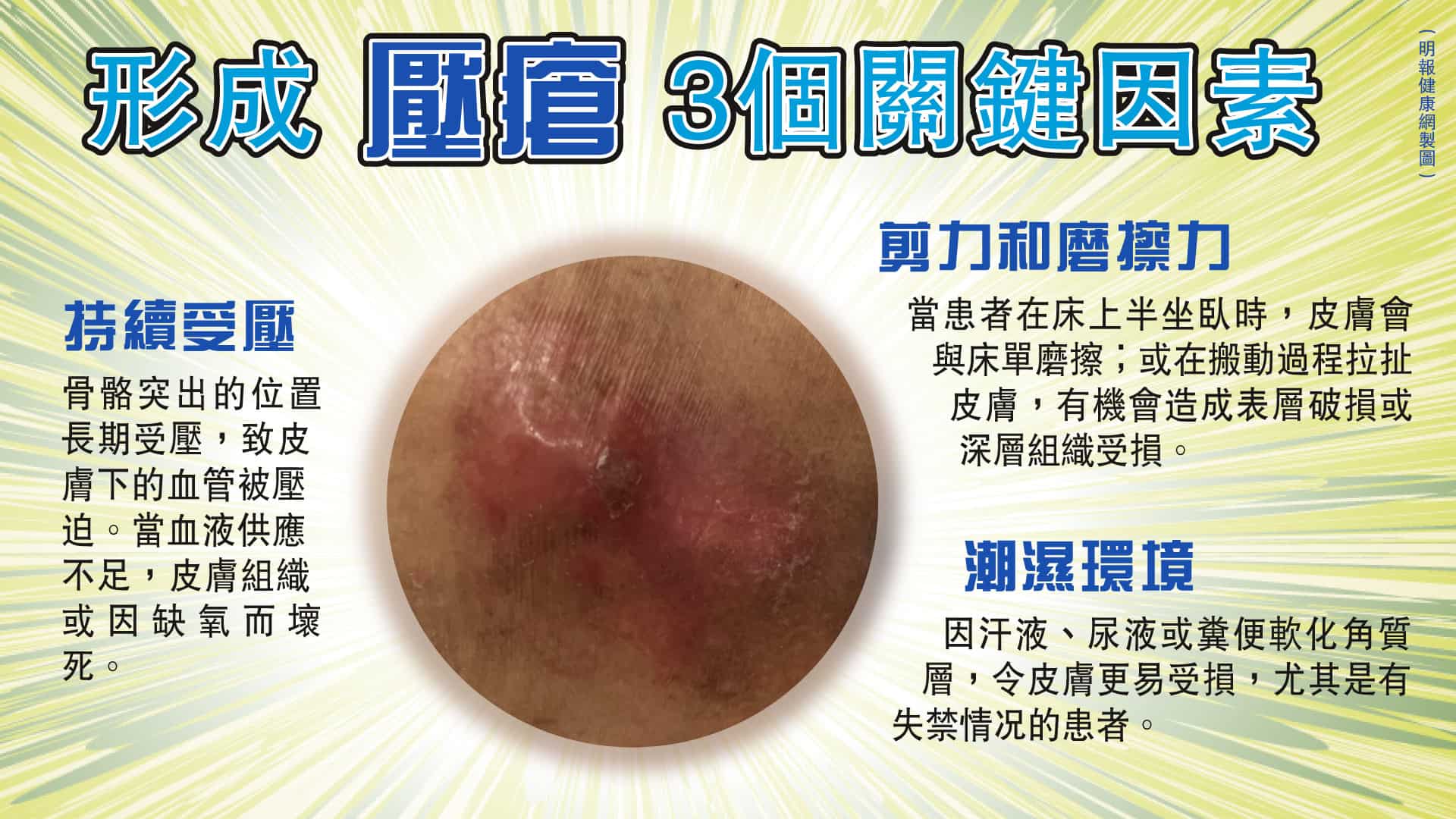 壓瘡初期似皮膚敏感?病情分4期 缺專業護理可急速惡化 4個預防方法 - 明報健康網