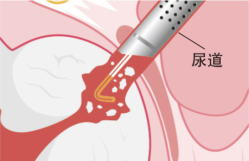 【良性前列腺增生】電刀刮除術 vs. 鈥激光剜除術 成效、安全度有何分別？