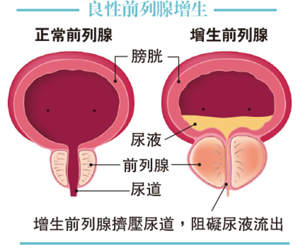 前列腺增生症狀:夜尿頻、滴滴仔、排尿難是癌症嗎?拆解4個迷思 前列腺增生症狀:夜尿頻、滴滴仔、排尿難是癌症嗎?拆解4個迷思