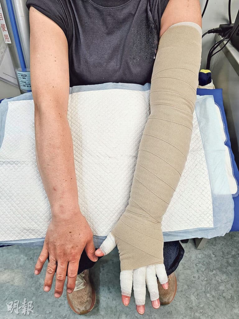 淋巴水腫是慢性發炎 病情分4期 了解整合性淋巴退腫治療