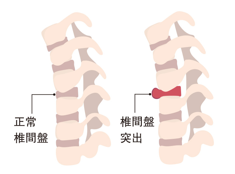 椎間盤突出常見腰頸椎 局部劇痛嚴重走路也困難 水中物理治療有效嗎? 椎間盤突出常見腰頸椎 局部劇痛嚴重走路也困難 水中物理治療有效嗎?