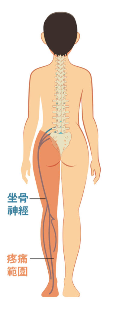 坐骨神經由腰椎的神經線匯合而成，穿過臀部、大腿後外側，最後在膝頭附近分支成兩條神經線，再延伸到小腿和腳掌。