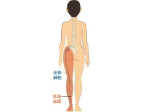 坐骨神經痛徵狀:下腰至小腿麻木刺痛 致下肢無力彎腰難