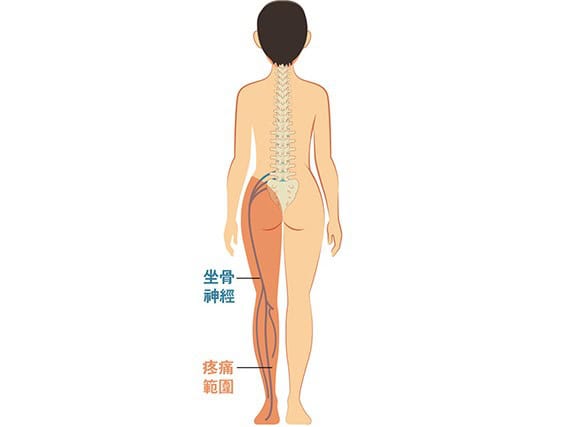 坐骨神經痛徵狀:下腰至小腿麻木刺痛 致下肢無力彎腰難