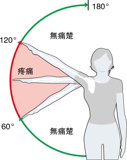 【痛症】 肩夾擊綜合徵？非肩痛元兇 運動重塑肌腱促進康復
