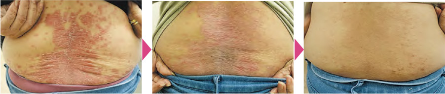 銀屑病又稱牛皮癬 冬天乾燥易發作 小心急性爆發 附3款湯水紓銀屑病之苦 銀屑病又稱牛皮癬 冬天乾燥易發作 小心急性爆發 附3款湯水紓銀屑病之苦