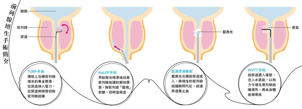 【前列腺問題】3種超微創手術治療前列腺增生 及早告別尿頻排尿難之苦 【前列腺問題】3種超微創手術治療前列腺增生 及早告別尿頻排尿難之苦