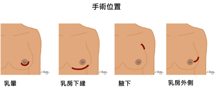 【乳癌手術】乳房保留重建手術:精準切除病灶及兼顧乳房外觀 術後電療減復發機會(附手術圖解) 【乳癌手術】乳房保留重建手術:精準切除病灶及兼顧乳房外觀 術後電療減復發機會(附手術圖解)