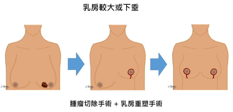 【乳癌手術】乳房保留重建手術:精準切除病灶及兼顧乳房外觀 術後電療減復發機會(附手術圖解) 【乳癌手術】乳房保留重建手術:精準切除病灶及兼顧乳房外觀 術後電療減復發機會(附手術圖解)