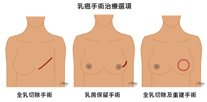 【乳癌手術】乳房保留重建手術:精準切除病灶及兼顧乳房外觀 術後電療減復發機會(附手術圖解) 【乳癌手術】乳房保留重建手術:精準切除病灶及兼顧乳房外觀 術後電療減復發機會(附手術圖解)